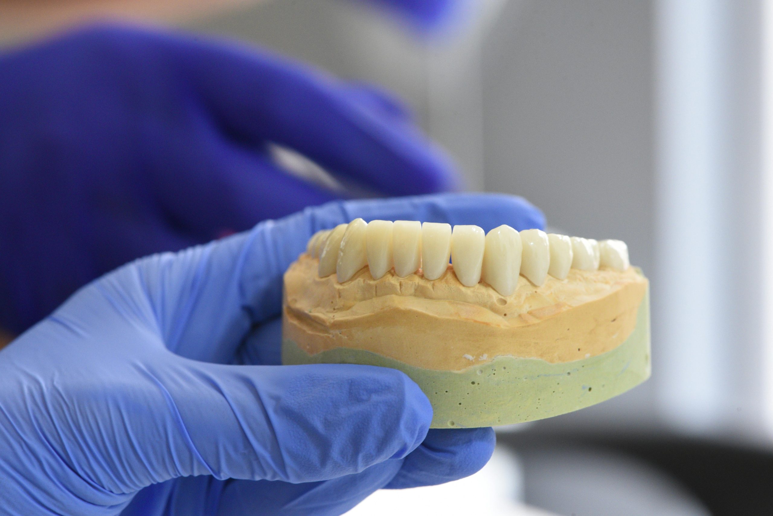 Dental Implants Last Longer - Tooth Implant Sydney