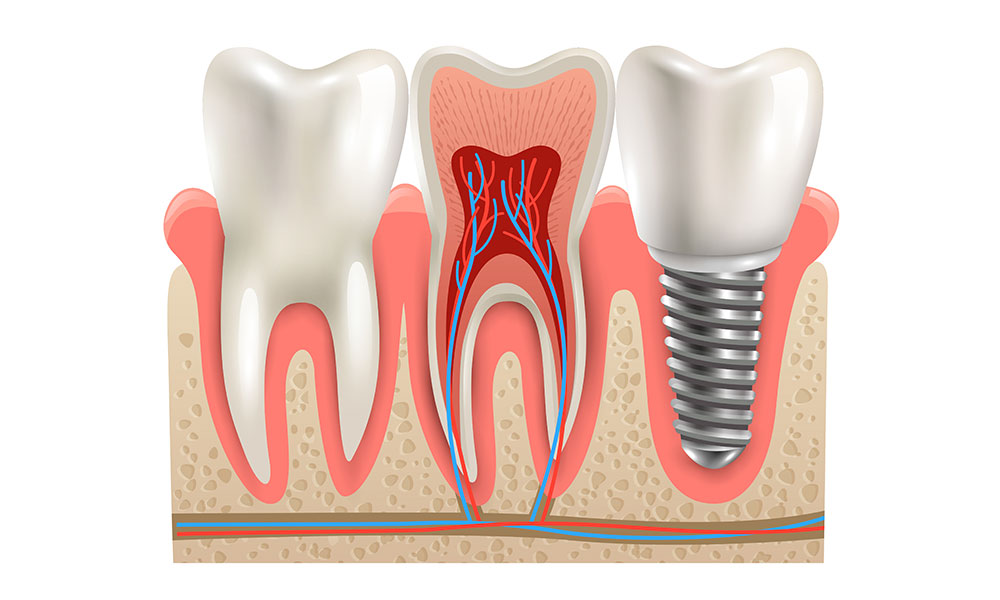 Dental implant procedure in Sydney - step-by-step treatment process