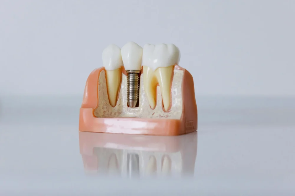 Dental model showing a single tooth dental implant post and crown restoration